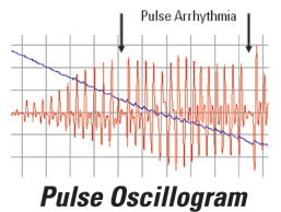 The curve below shows an oscillogram taken by a Microlife blood pressure monitor with PAD technology. The arrows indicate arrhythmia